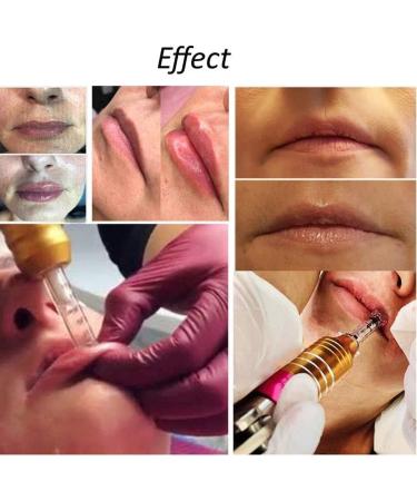 Hyaluronic acid injector for lip lifting and anti-aging wrinkle reduction with a 5-ampoule head - Buy Online on GoSupps.com