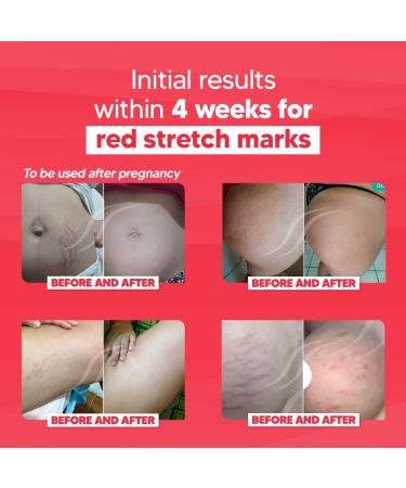 Cicatrissm Red Stretch Mark Remover Cream - Pregnancy & Tummy Care - Removes Red/Purple Stretch Marks - Skin Treatment - Buy Online on GoSupps.com