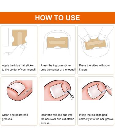 Ingrown Toenails Tool Set Toenail Correction Patch - Buy Online on GoSupps.com