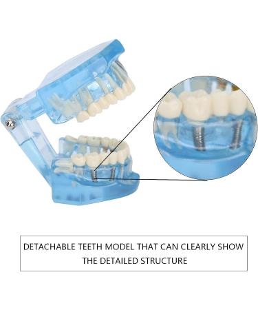 Adult Dental Implant Tooth Model - Blue-Transparent Acrylic for Pedagogical Demonstration | Removable Simulation for Dentists - Buy Online on GoSupps.com