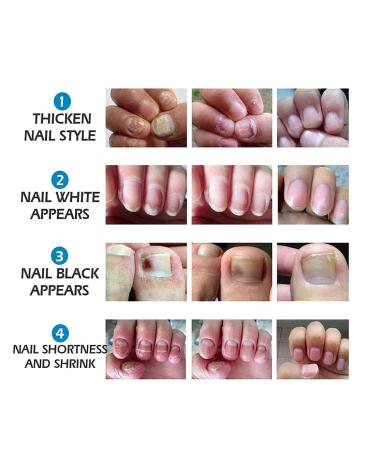 Maximum Strength Nail Fungus Treatment Cream - Antifungal Toenail & Fingernail Remover - Buy Online on GoSupps.com