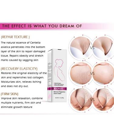 Best Stretch Mark Cream for Pregnancy & Postpartum - Repair & Remove Scars - Buy Online on GoSupps.com