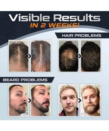 Bio Tech Advanced Regrowth Treatment Kit | Hair Growth Serum & Roller Essence Set for Women | Anti Hair Loss Solution - Buy Online on GoSupps.com