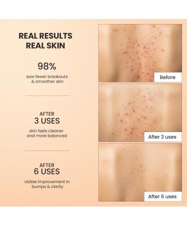 BellamiLuxx Body Acne Treatment Scrub: Helps Reduce Body Breakouts on Back Chest Butt & Thighs - Back Acne Treatment for Men Women & Teens - Butt Acne Wash with Natural Actives for Smooth Skin - Buy Online on GoSupps.com