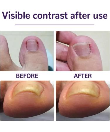 Grgowe Nail Correction Ingrown Toenail Corrector Foot Toenail Plasters Foot Correction Foot Toenail Correction for Care of Toenail Treatment Protect - Buy Online on GoSupps.com