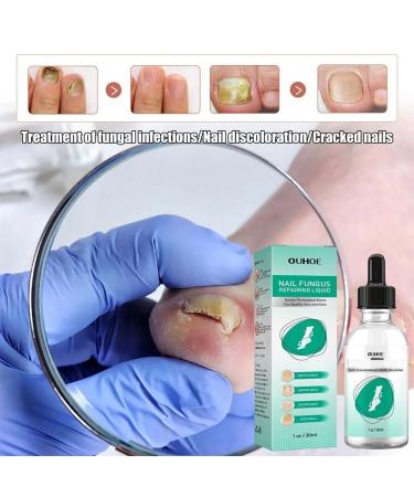 2Pcs Kerassentials Toenail Fungus Treatment - Healthy Skin, Hair & Nails Formula - Buy Online on GoSupps.com