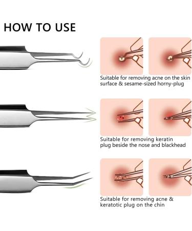 Japard Professional 5 Pcs Blackhead Remover Kit - Stainless Steel Tools for Acne, Pimple, Blemish, and Whitehead Removal on Nose and Face - Buy Online on GoSupps.com