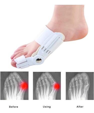 12-Piece Bunion Corrector & Soft Gel Toe Spreader | Hallux Valgus Relief & Toe Alignment - Buy Online on GoSupps.com