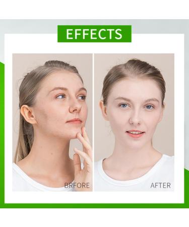 Centella Calming Gel Cream Centella Face Serum for Women Centella Moisturiser Face Moisturiser for Acne Prone Skin Hydrating Face Moisturizer for Women with Tea Tree Oil Centella Repair Face Cream - Buy Online on GoSupps.com