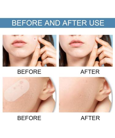 Buy Ikasus Acne Patch - 80 Hydrocolloid Pimple Dots with Tea Tree & Calendula Oil | Invisible Acne Absorbing Covers - 5 Sizes for Face & Body - International Shipping Available - Buy Online on GoSupps.com