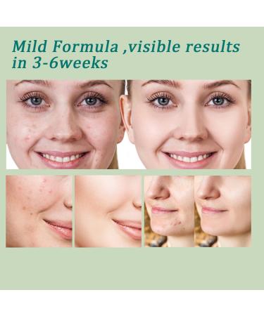 Azelaic Acid Facial Gel - Acne Treatment with Salicylic Acid & Ceramide | Redness Relief & Clarify Skin - 1 Fl. Oz - Buy Online on GoSupps.com