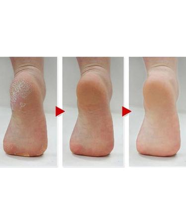 LUPO Callus Remover Tool - Effective Foot Heel Shaver & Scraper for Smooth Pedicures | International Shipping Available - Buy Online on GoSupps.com