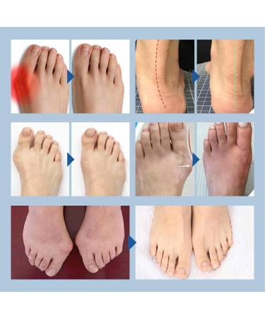 Jimtuze Reusable Silicone Gel Toe Stretcher for Foot Health Care | Ideal for Tennis Shoes, Flats, Heels, and Boots - Buy Online on GoSupps.com