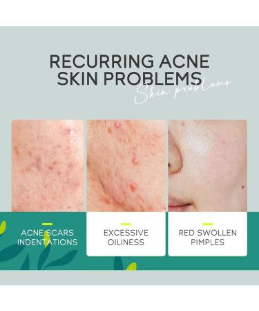 Anti Acne Face Cream Tea Tree Face Ance Gel Spot Cream for Acne Treatment and Spot Treatment Shrink Pores Acne Scars Recovery Control Sebum Secretion Relieves Inflammation Redness & Anti-Bacterial - Buy Online on GoSupps.com