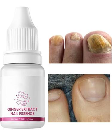 Strengthener for Damaged Nails Versatile Repair Care 10ml Cuticle Repair Oil - Yellow Foot and Nail Care - Ingrown Toenail Prevention - Men and Women - Buy Online on GoSupps.com