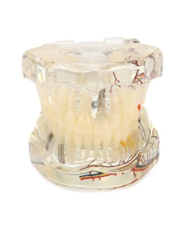 Verdant Touch Pathological Implant Model Transparent Dental Implant Pathological Model for Teaching Demonstration