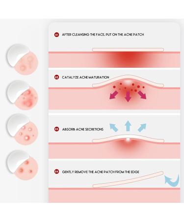 LacyMC Acne Patches - 60 Pack, 8mm & 12mm Hydrocolloid Dressing for Spots & Pimples - Buy Online on GoSupps.com