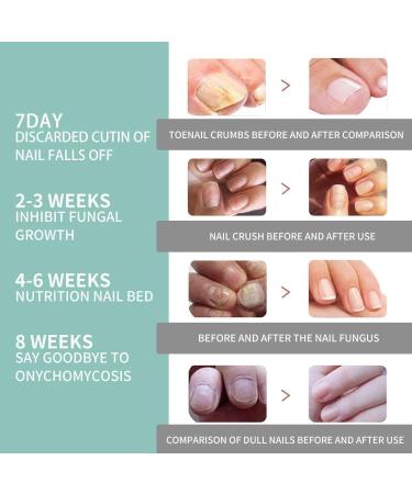 Nail Care Pen Set - 5PCs Nail Repair & Care Stick for Healthy Well-Groomed Fingernails & Toenails - Buy Online on GoSupps.com