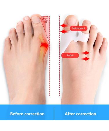 Xiongqi Silicone Toe Separators - 2 Pairs for Overlapping Toes & Bunions Relief | Toe Spacers & Smoothing Orthoses - Buy Online on GoSupps.com