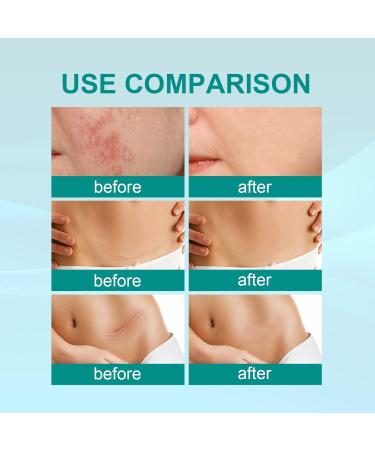 2Pcs Scar Remove Advanced Spray - Remove Dark Acne, Surgical Scars & Stretch Marks - Buy Online on GoSupps.com