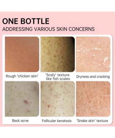 Keratosis Pilaris Lotion Legs Treatment Body Cream Skin Exfoliating Repair Cream Chicken Skin Care Cream Exfoliating Body Cream Rough Bumpy Skin Body Lotion Moisturizing Cream Gets Rid Of Redness - Buy Online on GoSupps.com