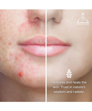 Nature's Uncut Organic Moringa Oil - 100% Pure Natural Skin & Hair Care Moisturizer Acne & Eczema Treatment 30ml - Buy Online on GoSupps.com