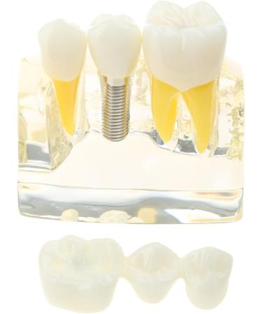 Implant Model Removable Bridge - Educational Teeth Model for Dental Studies | Perfect for Demonstration Classes - Buy Online on GoSupps.com