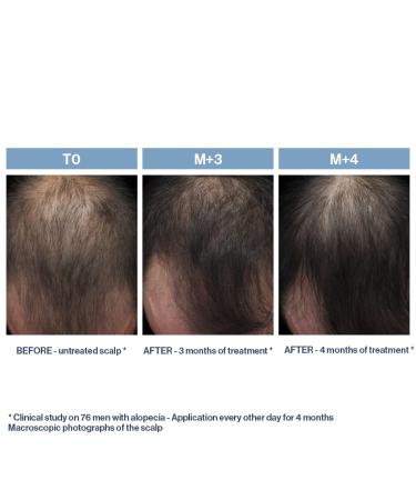 PHYTO PARIS Phytolium+ Treatment - 3.38 fl. oz. | Effective Hair Loss Solution | Shop Worldwide - Buy Online on GoSupps.com