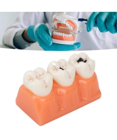 4-fold caries model for teaching tooth caries simulation and diagnostic procedures training of dentists and dentistry students portable and easy