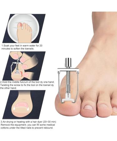 KARELLS Ingrown Toenail Correction Set Ingrown Toenails Set 12 Pieces Ingrown Toenail Lifter Ingrown Toenail Correction Treatment Set for Ingrown Toenails - Buy Online on GoSupps.com