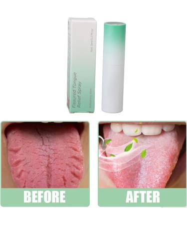 Fissured Tongue Relief Spray 2pcs Fissured Tongue Relief Spray 8ml Remove Odor Regulates Oral Health Breath Fresheners Oral Fissured Tongue Spray Fissured Tongue Sprayer - Buy Online on GoSupps.com