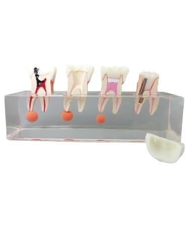 Dental Teeth Model 4-Stage Endodontic Treatment Model for Studying and Teaching