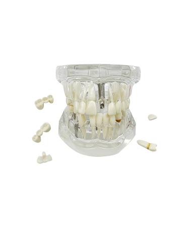 Transparent tooth model youya dental transparent tooth model for dentist standard disease removable pathological teaching model Transparent tooth implant-fawn model - Buy Online on GoSupps.com