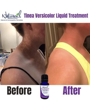 Naturasil Tinea Versicolor Topical Treatment 15mL - Eliminate Candida & Onychomycosis - Buy Online on GoSupps.com