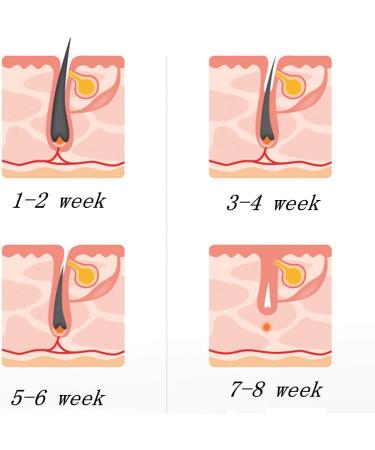 ICCouch Light Impulse Hair Removal Device | Painless Permanent Smooth Skin for Body Face & Bikini | International Shipping - Buy Online on GoSupps.com