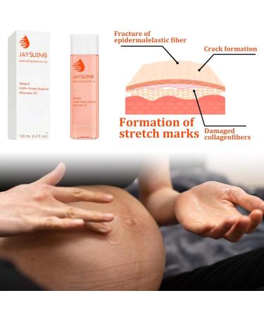 Pregnancy Oil for Stretch Marks - 125ml Massage & Body Oil to Improve Skin Texture & Even Tone - Buy Online on GoSupps.com