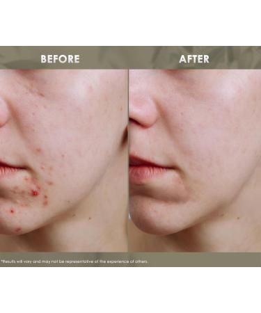 Redmint Acne Clear Facial Essential Oils | Made with 100% Organic TCM Herbal Ingredients Skincare |Natural Tried &True Acne Face Oil | Anti Acne Serum for Face to Skin Radiance| 20ml - Buy Online on GoSupps.com