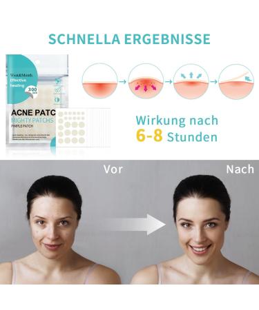 Day & Night 2-in-1 Waterproof Pimple Patches | Anti-Acne with Tea Tree Oil & Salicylic Acid | Thin Light Invisible | 300 Transparent Patches for Effective Acne Treatment - Buy Online on GoSupps.com