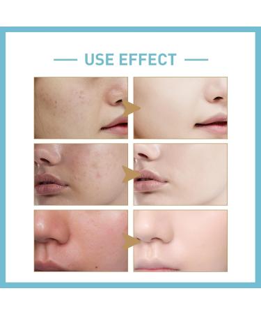 50Pads Glycolic Acid Pads 30% Face Cleansing Pads Reduces Fine Lines and Wrinkles Exfoliating Face Pads Exfoliates Surface Skin Acne Face Wipes Facial Pads Exfoliating Pads for Breakouts & Blackheads - Buy Online on GoSupps.com
