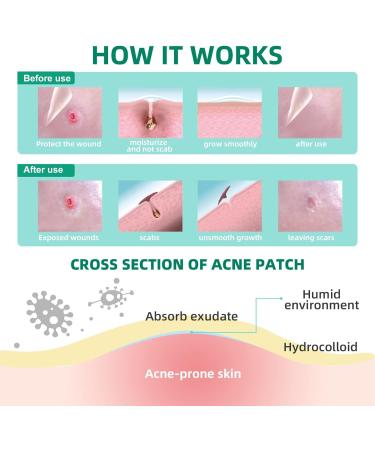 Buy Acotye Anti Pimple Patch - Hydrocolloid Acne Treatment with Tea Tree Oil & Salicylic Acid - Day & Night - 210 Pieces in 4 Sizes - International Shipping Available - Buy Online on GoSupps.com