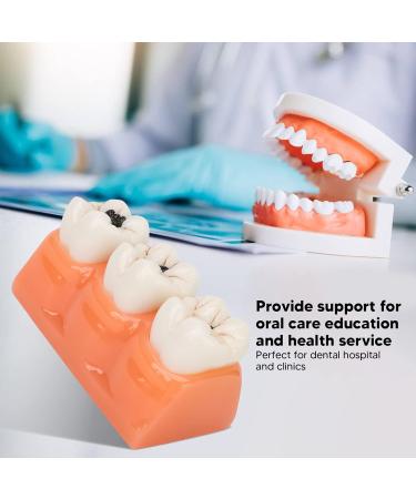 4-Fold Caries Model for Dental Education | Tooth Caries Simulation & Diagnostic Training | Portable for Dentists & Students - Buy Online on GoSupps.com