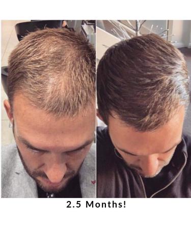 Laser Hair Growth Comb Brush for Men and Women - Hair Loss Treatment Device - Buy Online on GoSupps.com