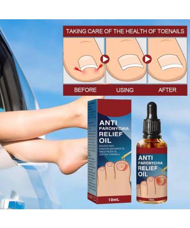 Ingrow Toenail Correction Treatment Oil Ingrown Toenail Correction Drops Cuticle Care Oils for Ingrown Toenails Nail Care and Treatment Ingrown Toenail Drops Ingrowing Toenail Treatment 10ML - Buy Online on GoSupps.com