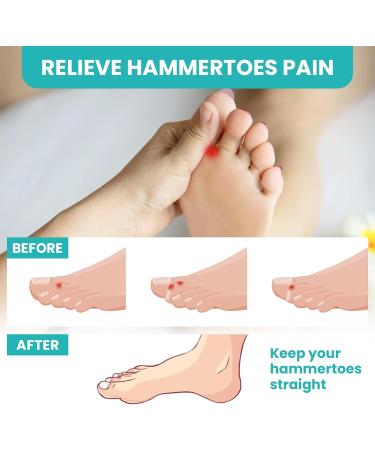 Buy Soft Gel Toe Separators - 2 Pairs for Bunion Correction & Foot Pain Relief | Ideal for Men & Women - Buy Online on GoSupps.com