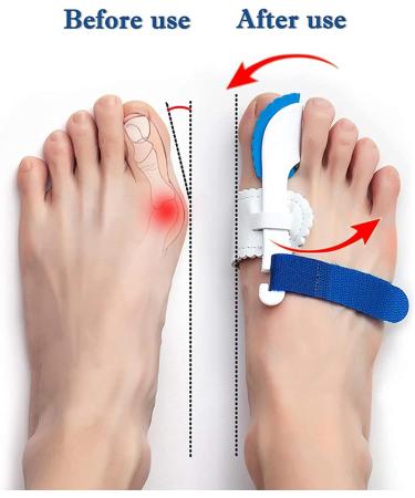 Buy Generic Bunion Corrector & Splints for Hallux Valgus Relief | Adjustable Big Toe Protector Kit (White One Size) - International Shipping Available - Buy Online on GoSupps.com
