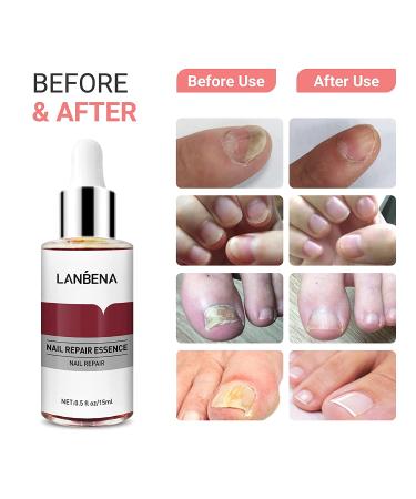 LANBENA Nail Repair Essence - Nail Repair Treatment for Damaged Nails - Protect, Cure and Restore Your Nails - 12ml - Buy Online on GoSupps.com