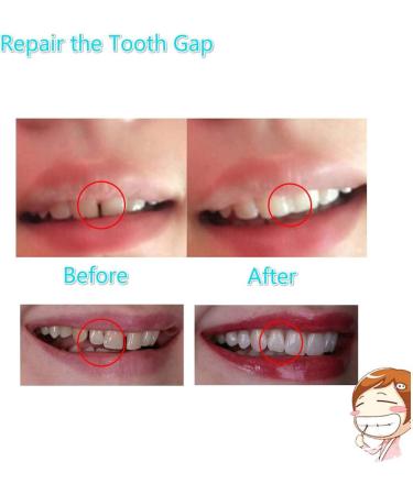Tooth Repair Kit - Instant Temporary Teeth Replacement for Damaged & Missing Teeth | Best Dental Fix Solution - Buy Online on GoSupps.com