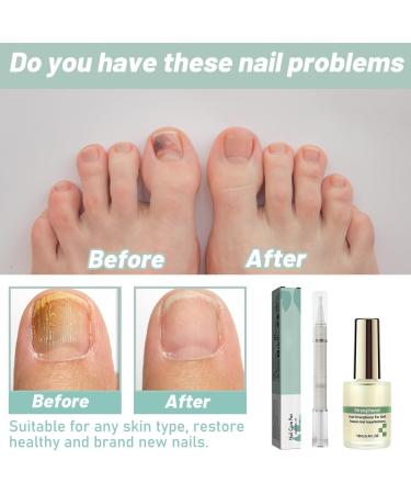 2 pi ces Stylo de Soin des Ongles+vernis poderm mycose ongle pied Traitement Mycose Ongle des Pied Puissant R paration Des Ongles Renforce et Revitalise Les Ongles Huile De Th ier et Romarin - Buy Online on GoSupps.com