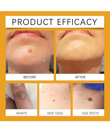 (100% Effective) 4/9 Jars Skin ag emover Bee enom Wart and ag emover | Bee enom Mole and Wart reatment Cream | ag ecede Bee enom Cream for Skin | 30G/1FL.OZ (9 Jars) - Buy Online on GoSupps.com