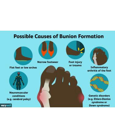 Algeos TheraStep Bunion Protector | Cushions and relieves pain from bunions - Buy Online on GoSupps.com